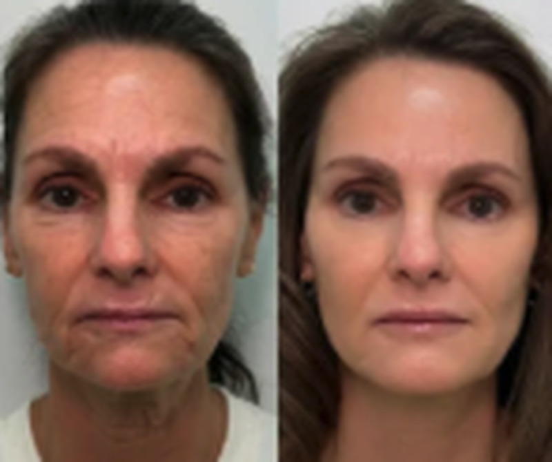 Antes e depois de Suzana Freitas usando o sérum FLOW