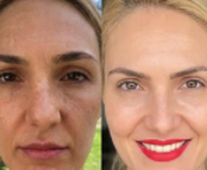 Antes e depois de Selma Almeida usando o sérum FLOW