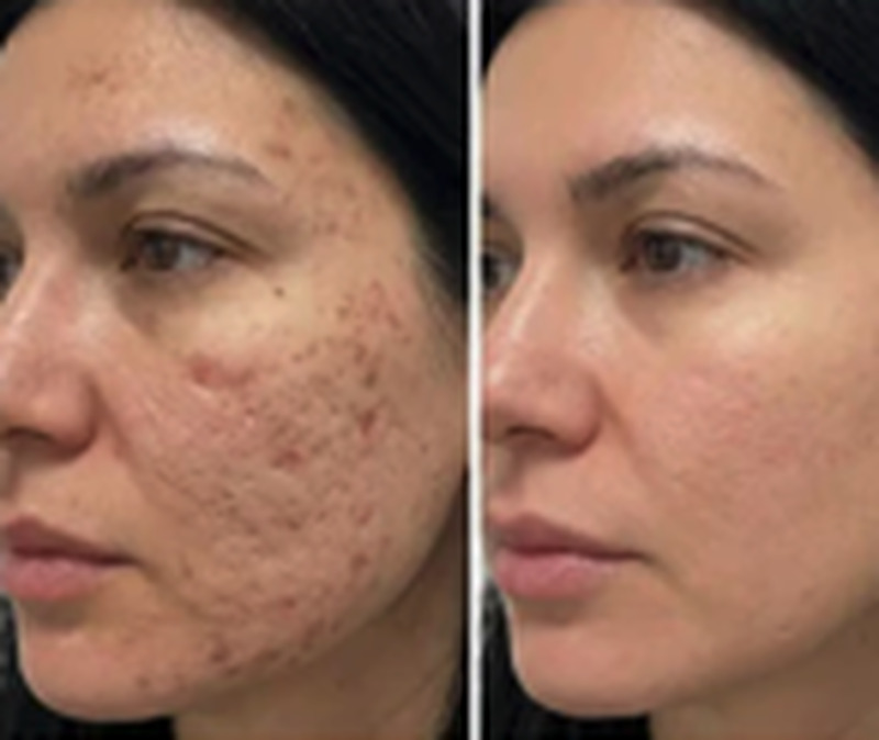 Antes e depois de Érika Rocha usando o sérum FLOW