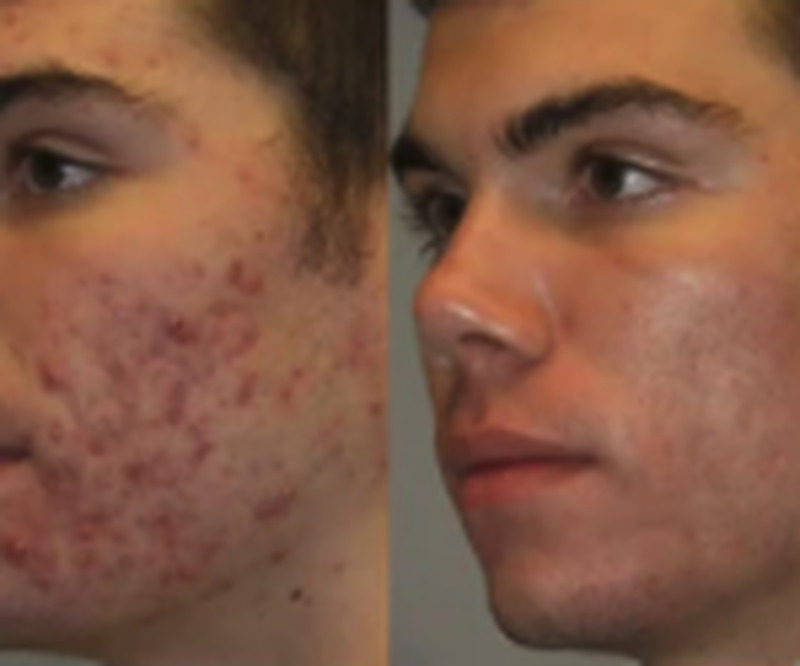 Antes e depois de Bruno Siqueira usando o sérum FLOW