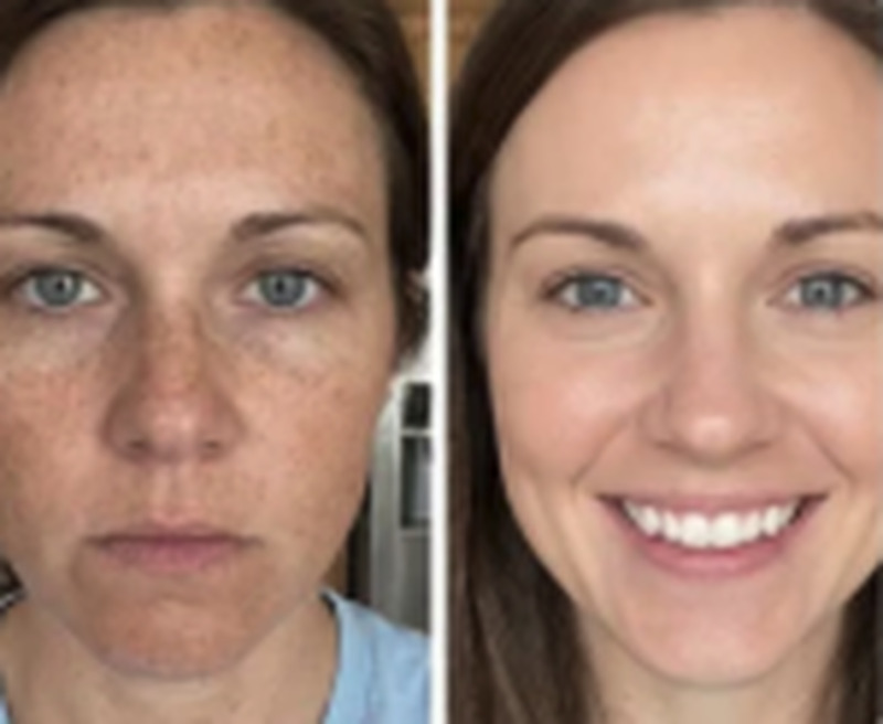 Antes e depois de Paula Machado usando o sérum FLOW